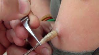 BOTFLY MAGGOT REMOVAL  Mango Worms in a GIRL