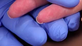 Perform a Capillary Puncture Obtain a Blood Sample by Capillary Puncture