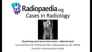 Closed loop small bowel obstruction - adhesive band Radiopaedia.org Cases in Radiology