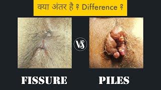 Piles vs Fissure - Difference ?