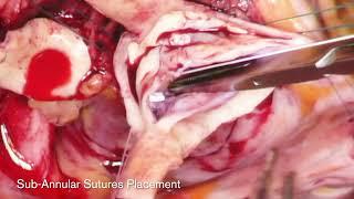 BAV Repair and Aortic Root Replacement Reimplantation