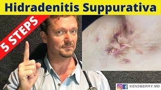 HYDRADENITIS SUPPURATIVA 5 Steps to Reverse HS