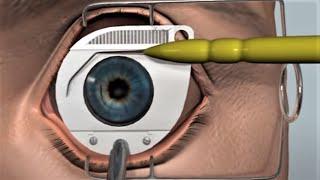 LASIK eye surgery - 3D animation