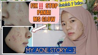 ALASAN BERHENTI PAKAI MS GLOW  My Acne Story 3