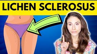 Lichen Sclerosus WHY YOU HAVE IT & HOW TO TREAT IT