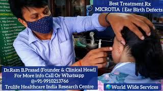 ? MICROTIA - Ear Birth Defect  Best Treatment - Silicone Ear Prosthesis by Dr.Ram B. Prasad Delhi