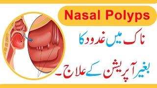 Naak ki Gadood ka ilaj in UrduHindi - Without Operation - Nasal Polyps Treatment - Naak ki Hadi