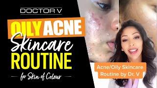 Doctor V - Oily Acne Skincare Routine For Skin of Colour  Brown Or Black Skin  #shorts