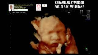 Kehamilan 37 minggu posisi bayi melintang