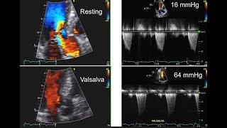 HCM Microlesson Case Example #3 The Walls of the Heart are Thick – Case of Amyloidosis