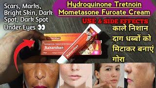 Hydroquinone Tretnoin Mometasone Furoate Cream  AAKARSHAN Cream  Use and side effects  in hindi