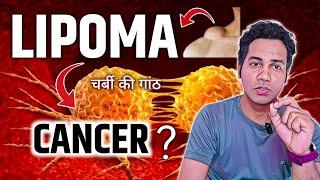  Can lipomas turn into cancer ? Dr tarun