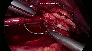 Laparoscopic Right Pyeloplasty Dr. Ahmet ŞAHAN