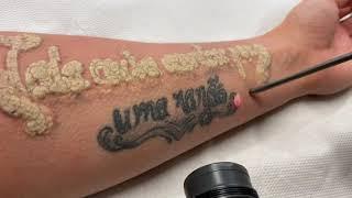 Detatouage Laser Tattoo removal Laser