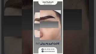 #beauty #skincare کاشت ابرو کرج دکتر میمند متخصص پوست #پوست_مو #hair