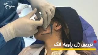 زاویه سازی و فرم دهی فک با تزریق ژلکلینیک رایان سلامت