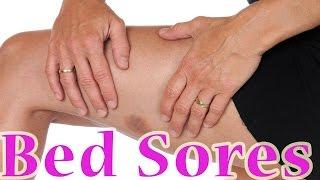 Bed Sores  Treatment For Bed Sores at Home    Pressure Ulcers Decubitus Ulcer Home Remedy