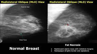 Mammography Normal Vs Abnormal Images  BI-RADS Classification  Breast Cancer & Other Diseases