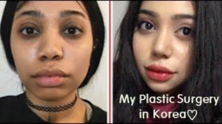 Best Korean Plastic Surgery Clinic Rhinoplasty & Facial Contouring Surgery Review