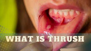 What is Thrush From Cozy Birds to Uncomfortable Infections