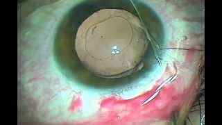 Management of subluxated lens with Cionni tension ring