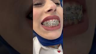 تقويم الأسنان لغلق العضه المفتوحة open bite #dr_abdullah_sultan_dentist #beach #orthodontics #trav