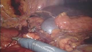 Standardized Totally Robotic Complete Mesocolic Excision for Right Sided Colon Cancer