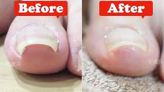 Gummy nail treatment for thumb｜Foot problem nail treatment case｜Gummy nail can nail