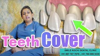 Dental Veneer Cover in Smile Kochi dental