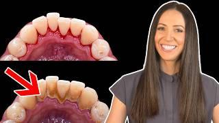 How To Remove Difficult Calculus as a Dental Hygienist