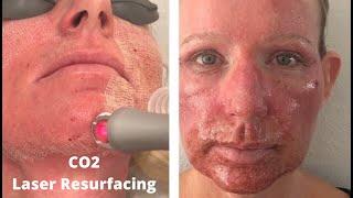 CO2 Laser Resurfacing  CO2RE