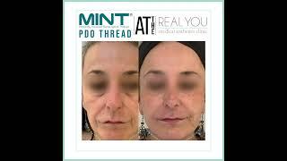 MINT Minimally Invasive Nonsurgical Thread PDO - Instagram Clip - Real You Clinic