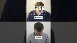 FUE hair transplant - result after 12 months #recedinghairline #fuehairtransplant