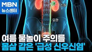 여름 감기인 줄 알았는데…몸살 같은 급성 신우신염 MBN 뉴스센터