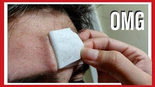 #Blackhead #asmr removal peel off Forehead Cheeks & Nose strips ULTRA HIGH QUALITY close up.