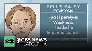 What is Bells palsy? What to know about symptoms and treatments