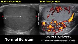 Varicocele Grading On Color Doppler Ultrasound  Grade 1-5 Varicocele  Scrotum & Testis USG