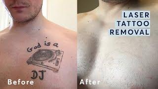 Laser Tattoo Removal - Before and After through all the stages