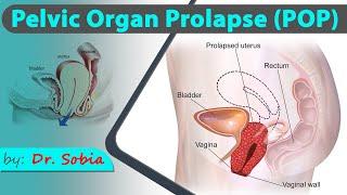 Pelvic Organ Prolapse and its Physical Therapy Treatment  Dr. Sobia