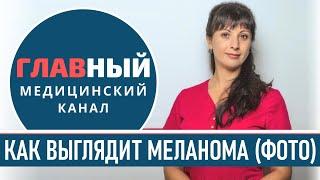 Как выглядит МЕЛАНОМА фото 1-9. Симптомы и признаки меланомы. Как определить рак кожи