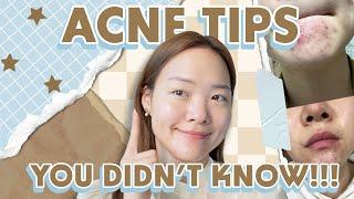Acne Tips that You didnt know but SHOULD be following