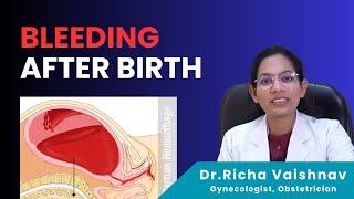 Bleeding after delivery  Postpartum delivery  प्रसव के बाद रक्तस्राव   Dr. Richa Vaishnav 