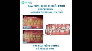 CLINCHECK KHÁCH HÀNG INVISALIGN- NIỀNG RĂNG MÓM TRONG 8 THÁNG