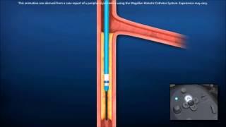 Lower Extremity PAD Treatment with Robotics