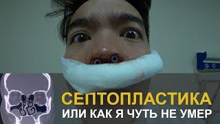Кривая перегородка и как промывать нос после операции