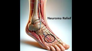 How to solve a Mortons Neuroma
