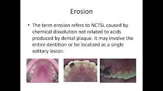 Tooth Wear Management. Prof Noor Adden Abo Arsheed