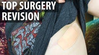 Top Surgery Scar Revision Dr. Garramone  Nonbinary Top Surgery