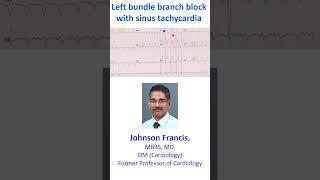 Left bundle branch block with sinus tachycardia