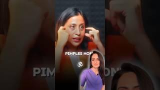 Acne face mapping  can acne show problems in internal organs  dermatologist comments